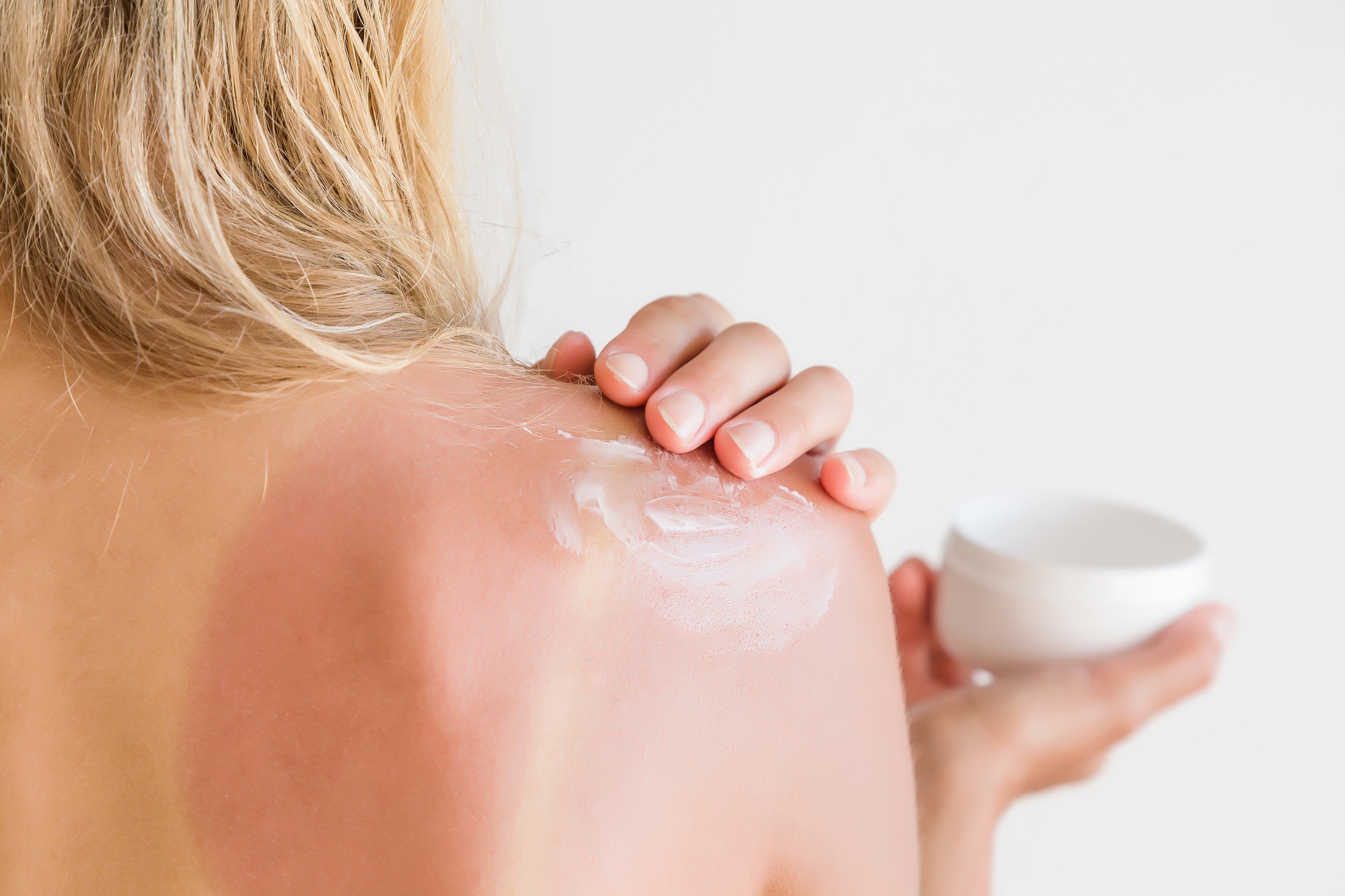 10 home remedies for sunburns that provide instant relief